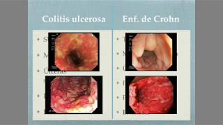 Colitis ulcerosa Vs Enfermedad de Crohn [upl. by Rad]