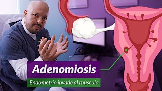 Cirugía por Adenomiosis Y diferencia con miomas y endometriosis [upl. by Stortz]