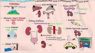 Polycythemia  Part 2 [upl. by Cleaves221]