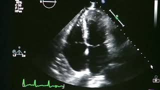 Afib Aflutter Junctional Arrhythmias  ECG EKG Interpretation Part 4 [upl. by Akined]