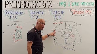 Tension Pneumothorax  Diagnosis amp Management🩺 [upl. by Nisse457]