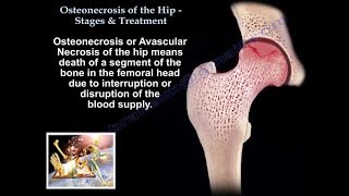 Osteonecrosis Of The Hip Stages amp Treatment  Everything You Need To Know  Dr Nabil [upl. by Augy812]