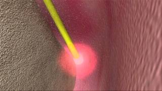 Laser Periodontal Therapy  WPT™ Animation [upl. by Valente933]