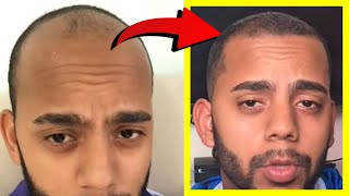 Crazy Minoxidil 5 Hair Growth in 25 Months Fails after 25 YEARS Heres WHY [upl. by Sansbury]