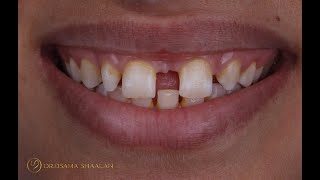 Combined approach for large diastema closure part II [upl. by Utley757]