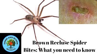 Brown Recluse Spider Bites What you need to know [upl. by Allen]