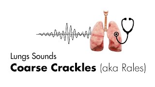 Coarse Crackles Rales  Lung Sounds  Medzcool [upl. by Ivory]