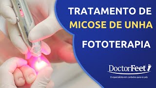 Tratamento de Micose de Unha com Laser  Fototerapia [upl. by Nnylhtak910]