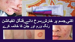 Travocort Cream Best Cream For Skin Problems Men amp Women [upl. by Rubel72]