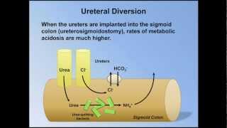 Normal Anion Gap Metabolic Acidosis ABG Interpretation  Lesson 9 [upl. by Attennek]