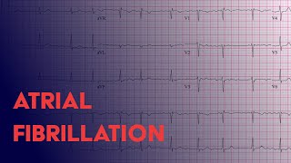 Ventricular Fibrillation V Fib amp Sudden Cardiac Death [upl. by Jacinta572]