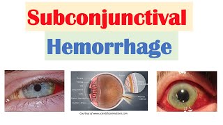 Subconjunctival Hemorrhage Blood in Eye  Causes Signs amp Symptoms Diagnosis Treatment [upl. by Deuno]