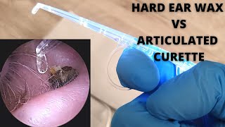 Hard Ear Wax VS Articulating Curette [upl. by Naanac]