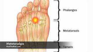 Metatarsalgia Foot Pain Causes Symptoms amp Treatments [upl. by Jarad]