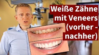 Weiße Zähne mit Veneers vorher  nachher 2021 [upl. by Aneri]