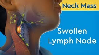 Neck Liposuction Cost Recovery amp Techniques  Kirkland Bellevue amp Seattle [upl. by Naivatco]