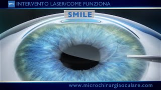 Intervento Laser Occhi Come Funziona [upl. by Batish]