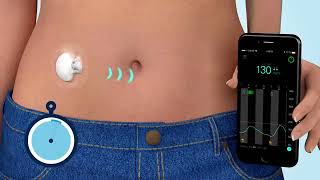 What is Continuous Glucose Monitoring CGM [upl. by Larina]