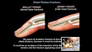 Distal Phalanx Fractures  Everything You Need To Know  Dr Nabil Ebraheim [upl. by Cordie]