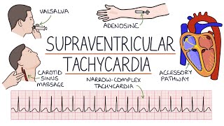 Ventricular Tachycardia Emergency [upl. by Hcardahs241]