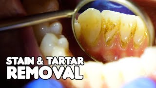 Dental Cleaning EXPLAINED  Stain amp Tartar Removal [upl. by Alaunnoif]