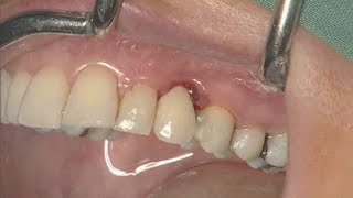 NobelActive clinical case immediate implant placement  Eric Rompen [upl. by Lenes]