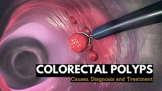 Colorectal Polyps Causes Signs and Symptoms Diagnosis and Treatment [upl. by Sparke]