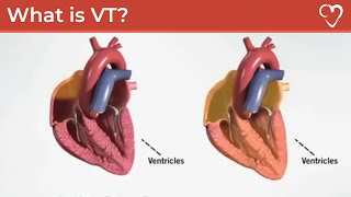 Ventricular Fibrillation Animation Video [upl. by Eenat]