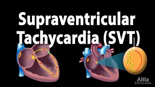 Supraventricular Tachycardia SVT PSVT Animation [upl. by Nytram]