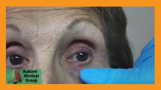 A Stye and a Chalazion  Auburn Medical Group [upl. by Alithia]