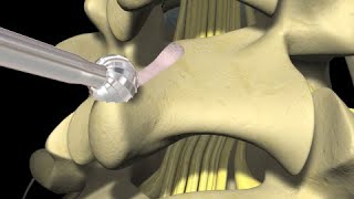 Low Back Pain Lumbar Laminectomy Surgery [upl. by Ahter]