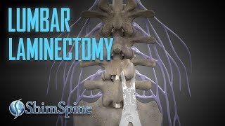 Lumbar Laminectomy [upl. by Eiknarf385]