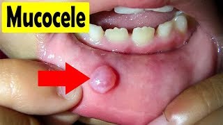 How to cure Mucocele  Home Remedies for a Mucocele [upl. by Wieche341]