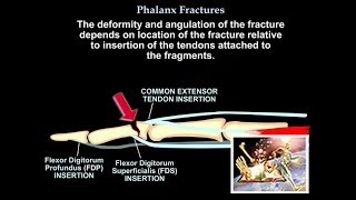 Phalanx Fractures  Everything You Need To Know  Dr Nabil Ebraheim [upl. by Anah]