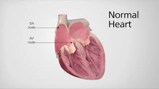 Atrial Fibrillation Overview  ECG types pathophysiology treatment complications [upl. by Giarla]