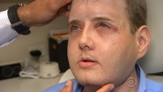 Face transplant recipient thriving one year after surgery [upl. by Marthe]