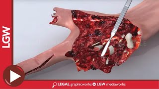 Debridement Myths for Youtube Video [upl. by Atnamas699]