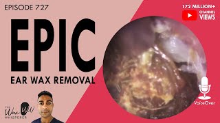 727  Epic Ear Wax Removal [upl. by Agon]