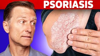 Psoriasis Treatment – The Best 3 Remedies for Psoriasis – DrBerg [upl. by Egdamlat]