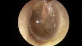 Serous Otitis Media [upl. by Pernell]