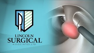 Polyp Removal  Dr Deirdre Hart Colon and Rectal Surgeon  Lincoln Surgical Associates Shiloh IL [upl. by Fassold517]