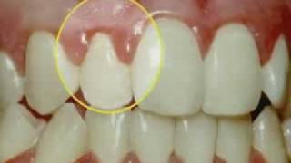 Periodontal Disease amp Treatment [upl. by Gonsalve396]