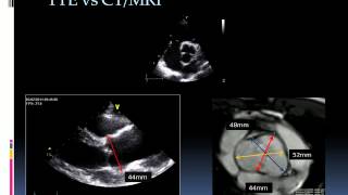 Echocardiographic assessment of bicuspid aortic valve [upl. by Yanal711]