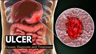 Acute Gastritis Stomach Inflammation  Causes Signs amp Symptoms Diagnosis Treatment [upl. by Fillender]