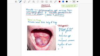 Ranula  Etiology Clinical Features amp Treatment  Surgery  Dr Shankar Dey [upl. by Nwahsal]