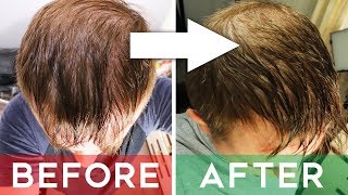 Finasteride Review  Does It Cure Hair Loss  Finasteride Before and After 8 months [upl. by Dabney]