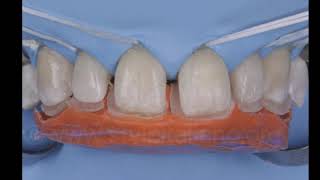 Multiple Diastema closure and ReCentering a Midline Deviation [upl. by Ahearn248]