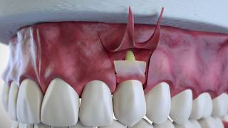 Subepithelial Connective Tissue Grafting [upl. by Eryn83]