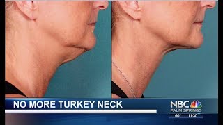 Double Chin Liposuction With Smartlipo™  Dr Sterry Explains [upl. by Dazhahs143]