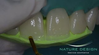 Fechamento de Diastema e Aumentos Incisais [upl. by Mcquillin]